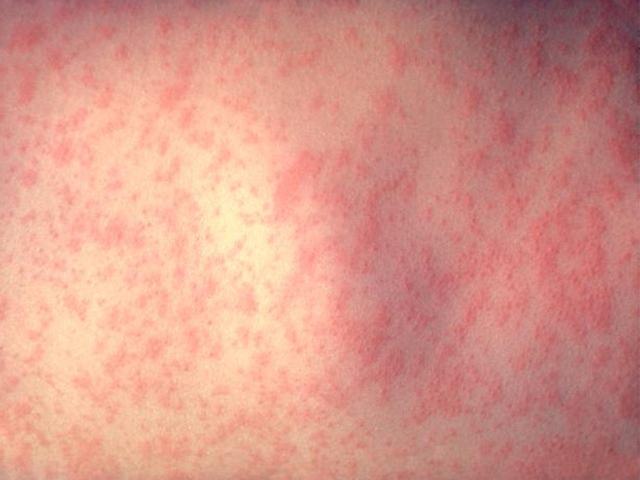 Michigan Health Department reminds families to get vaccinated following measles cases