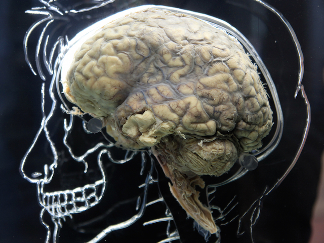 Can poor sleep lead to Alzheimer's or dementia?
